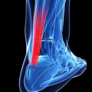 Image for Achilles Tendinopathy