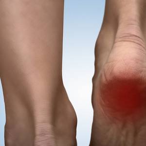 Image for Heel Pain (Plantar Fasciitis)