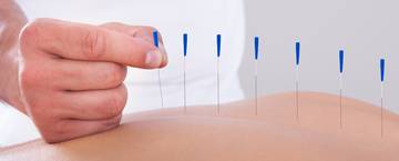 Index acupuncture