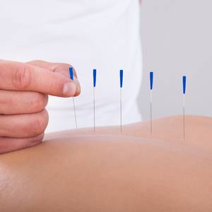 Image of Acupuncture